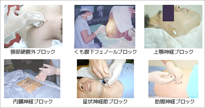 図1 各種神経ブロック